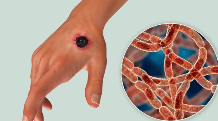 অ্যানথ্রাক্সের উপসর্গে নারীর মৃত্যু